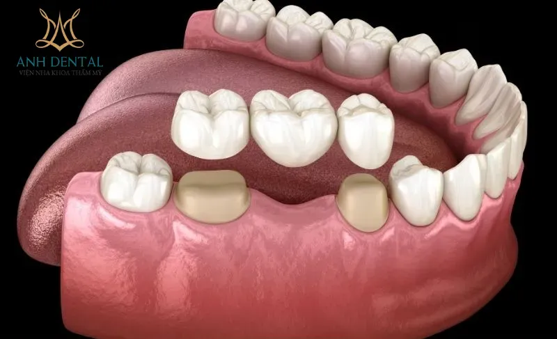 Các Cách Trồng Răng Sứ Phổ Biến: Ưu Điểm Và Quy Trình Chi Tiết