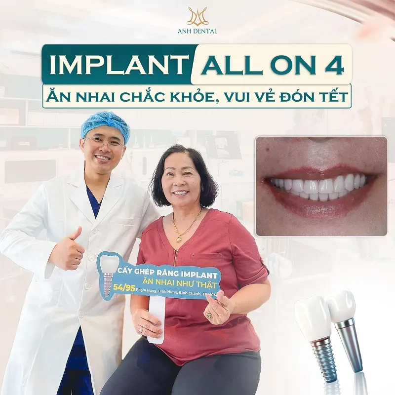 Các Cách Trồng Răng Sứ Phổ Biến: Ưu Điểm Và Quy Trình Chi Tiết