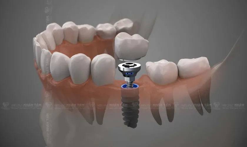 Cấy ghép răng Implant