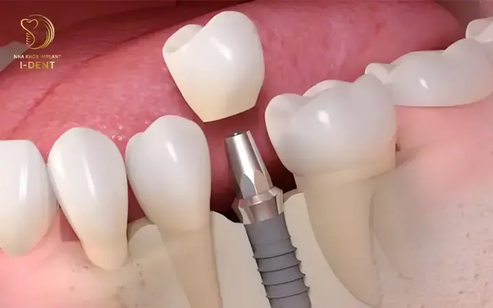 Tiêu chí quan trọng để lựa chọn phương pháp phục hình răng cấm