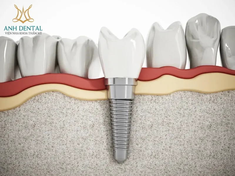 Mô hình chi tiết cấu tạo của một chiếc răng Implant bao gồm trụ Implant, khớp nối Abutment và mão răng sứ