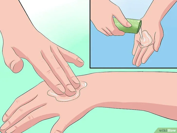 Gel nha đam được dùng để làm dịu da khi bị cháy nắng hoặc bỏng nhẹ